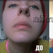 VIDEO: Anastasia Shpagina became a victim of a plastic surgeon